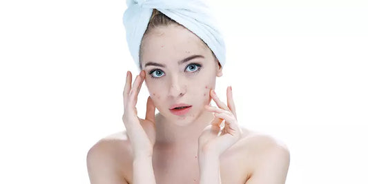 Biggest Skincare Mistakes That Are Causing You Acne