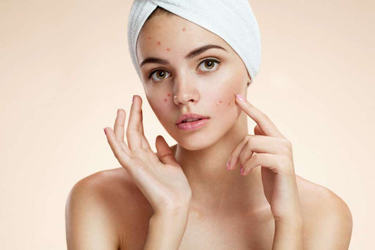 Glow Up: Transforming Acne-Prone Skin with Expert Tips