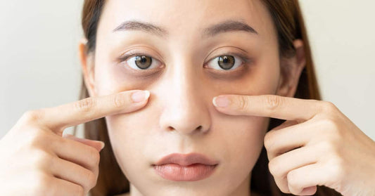 How to Get Rid of Dark Circles and Puffy Eyes