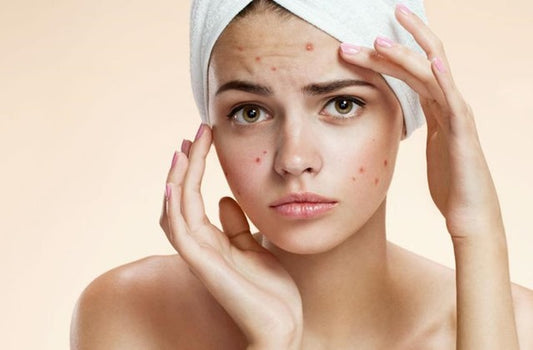 The Art of Clear Complexions: A Guide for Acne-Prone Skin