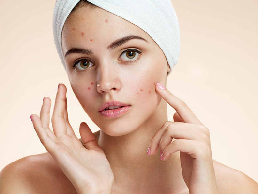 Battling Blemishes: A Holistic Approach To Acne-Prone Beauty