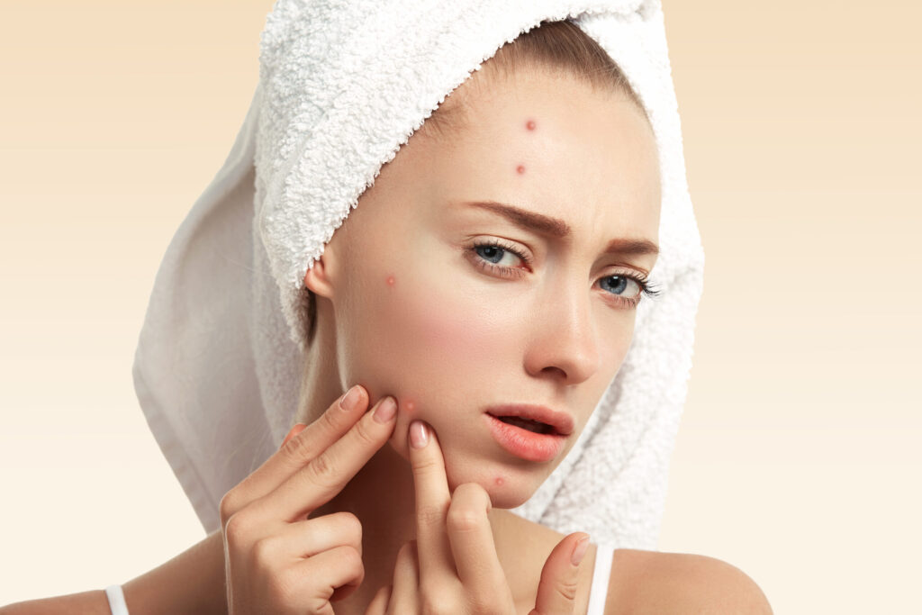 Revolutionize Your Routine: A Fresh Approach To Acne-Prone Skincare