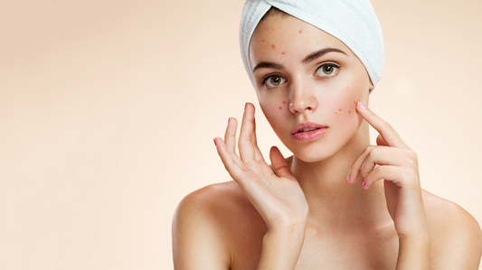 Breaking The Cycle: Effective Solutions For Acne-Prone Skin