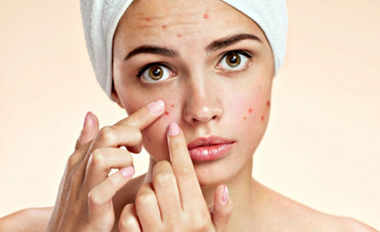 From Pimples To Perfection: A Comprehensive Acne-Prone Skincare Routine