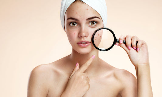 Explaining The Significance Of Toning In Acne-Prone Skincare