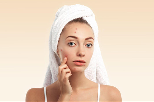 Unlocking Beauty: A Holistic Guide To Caring For Acne-Prone Skin