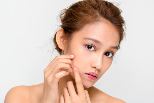 Spotless Beauty: Strategies For Managing Acne-Prone Skin