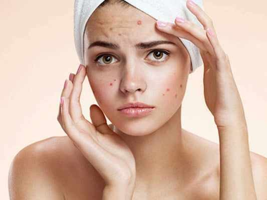 The Best Skincare Products For Acne-Prone Skin